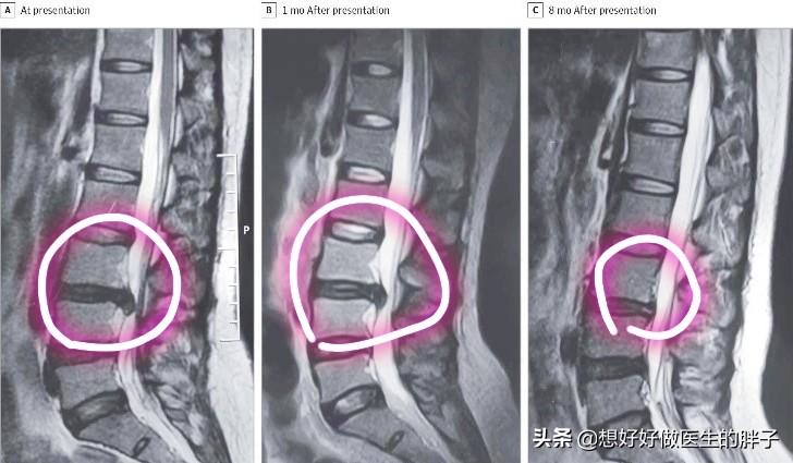 腰間盤突出新治療法及其步驟指南